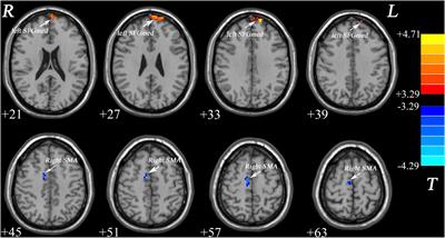 Global Functional Connectivity Analysis Indicating Dysconnectivity of the Hate Circuit in Major Depressive Disorder
